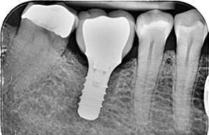 DIENTES03